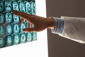 traumatic brain injury