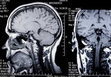Columbia Brain Injury Attorneys