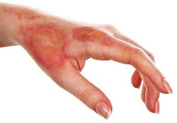 Bamberg Burn Injury Lawyers